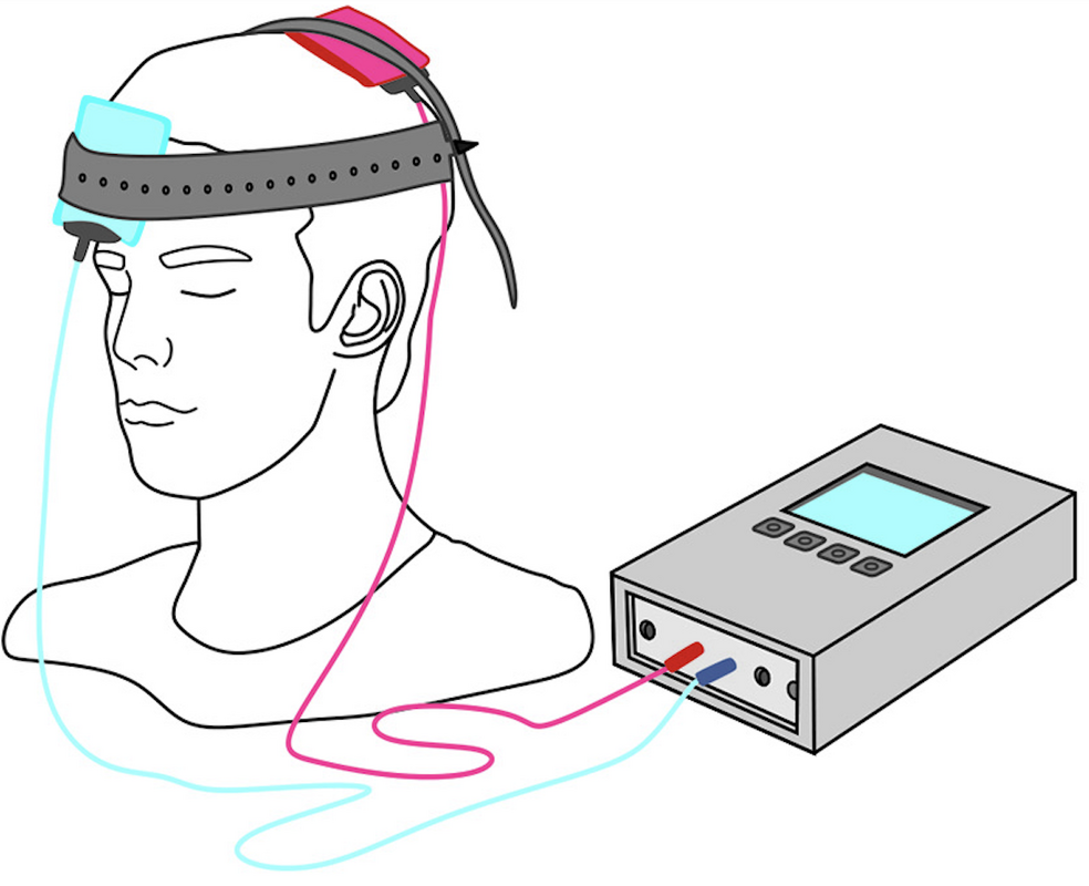 tES 示意圖:頭皮電極連接刺激器